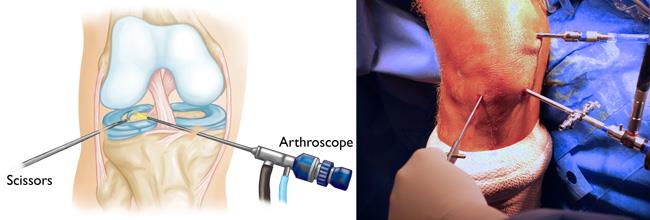Illustration and photo of arthroscopic portals in a knee