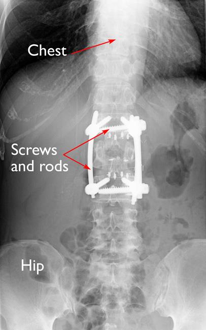 Spinal stabilization using screws, rods, and cages