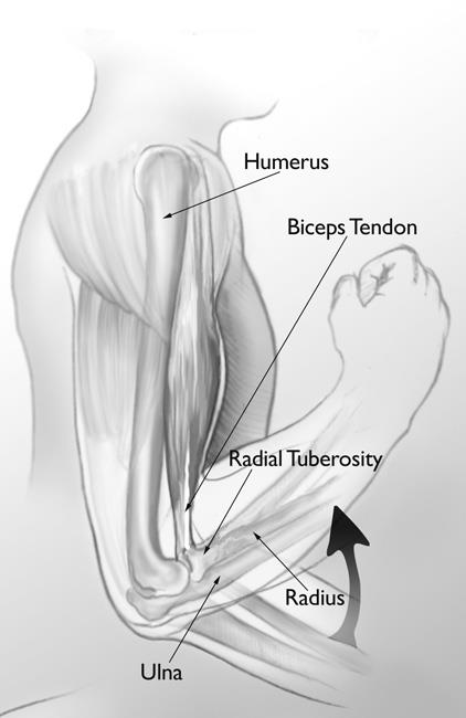 Biceps Tendon Tear at the Elbow - OrthoInfo - AAOS