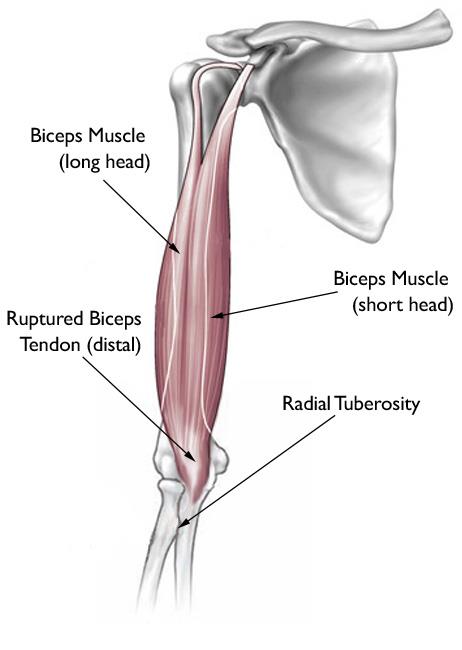 biceps-tendon-tear-at-the-elbow-orthoinfo-aaos