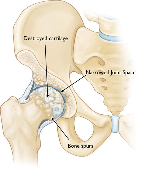 A hip with osteoarthritis