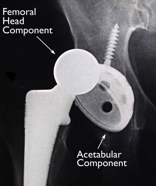 Hip implant dislocation