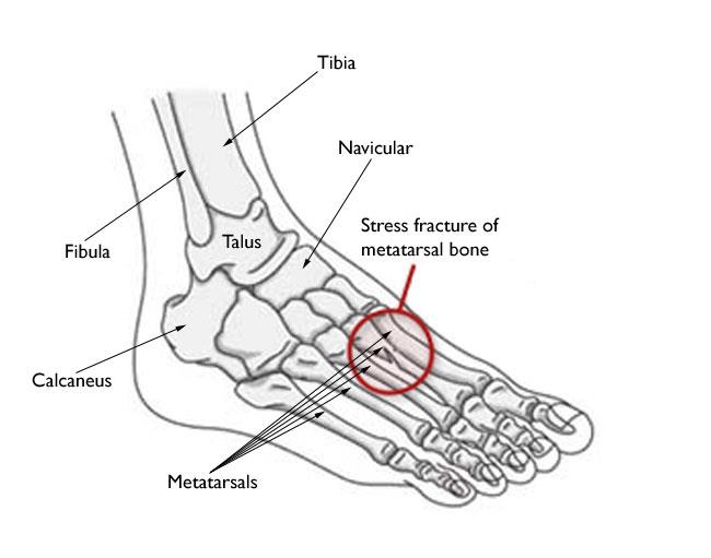 The most common sites for stress fractures in the foot are the metatarsal bones. 