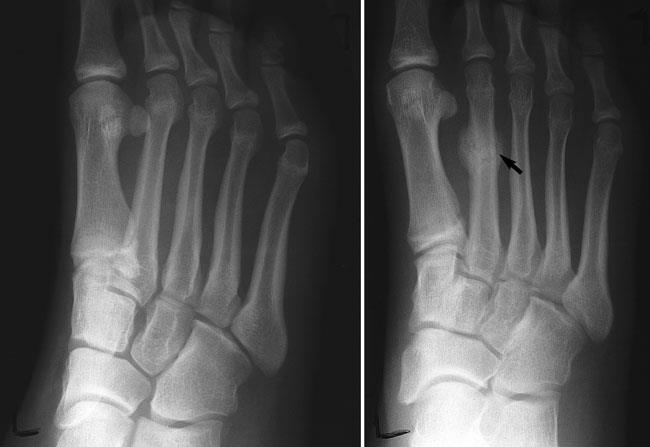 x-ray of stress fracture in metatarsal