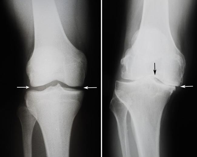 x-rays of a healthy knee and a knee with osteoarthritis