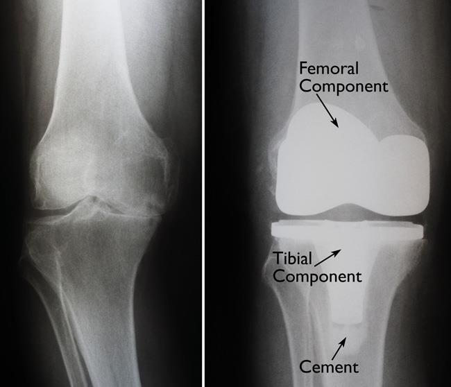 x-rays of severe knee arthritis and knee replacement