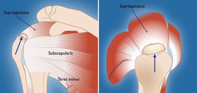 Front and overhead view of a rotator cuff tear in the supraspinatus tendon
