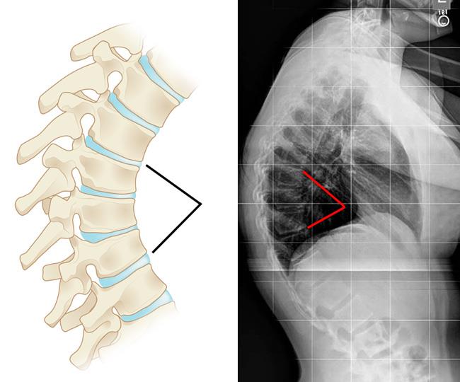 Illustration and x-ray of vertebral wedging
