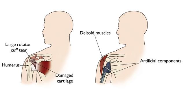 Illustrations of rotator cuff arthropathy and reverse total shoulder replacement