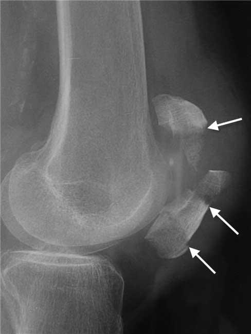 x-ray of kneecap broken in three places