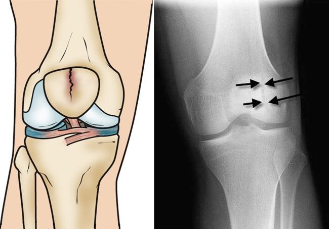 patellar-fractures-broken-kneecap-orthoinfo-aaos