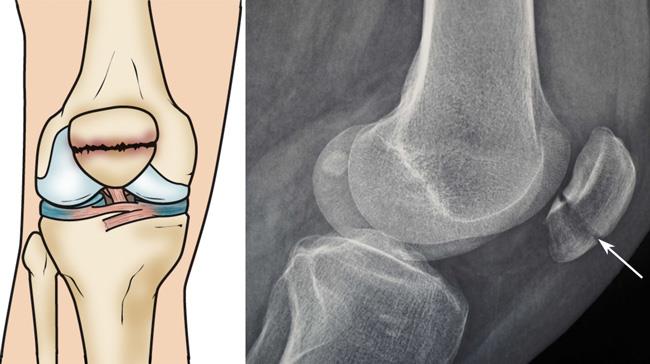 Illustration and x-ray show a transverse patella fracture