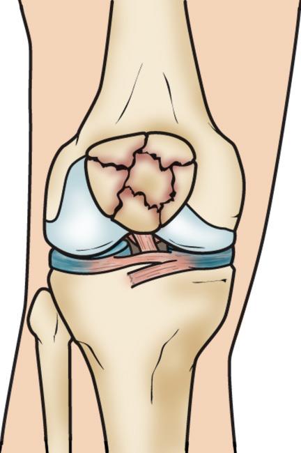 A comminuted fracture of the patella. 