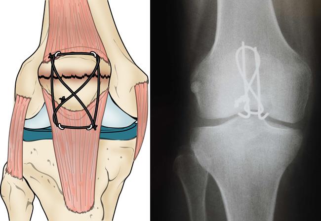   a figure-of-eight tension band holds a patellar transverse fracture together