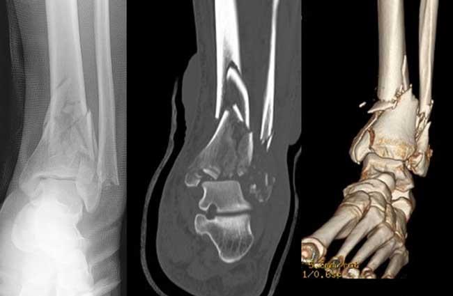 X-ray and CT scan of a pilon fracture