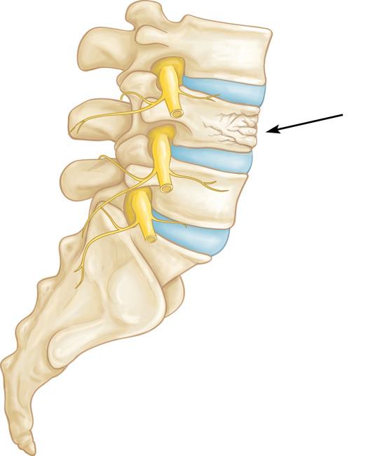 A vertebral compression fracture