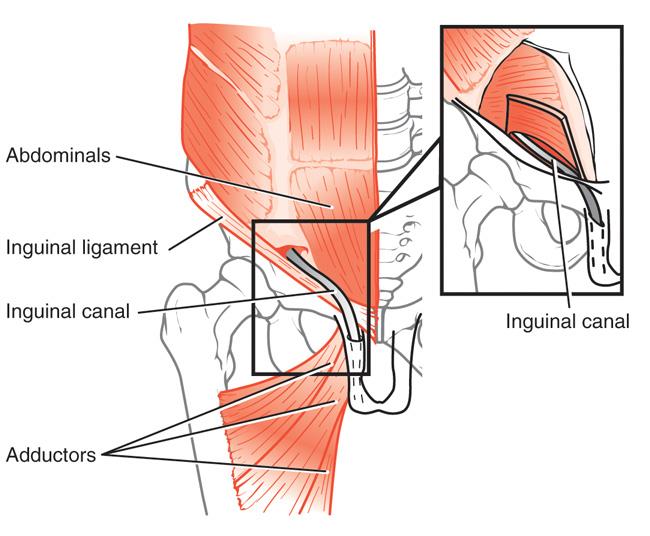Sports hernias often occur where the abdominals and adductors attach at the pubic bone. 