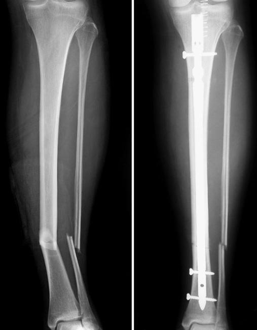 internal fixation for tibial fracture