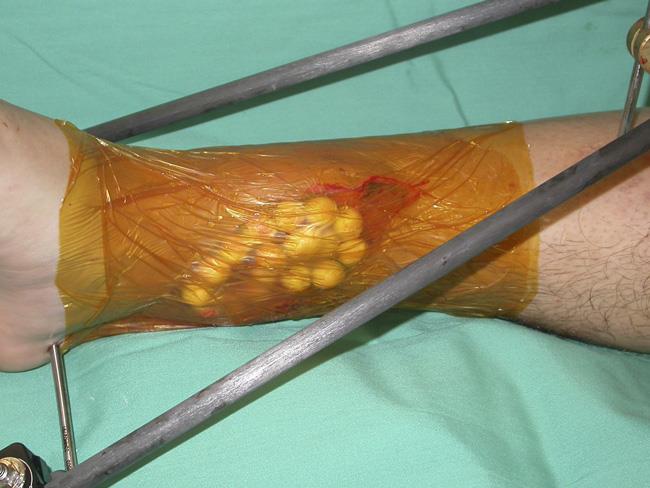 Antibiotic beads used to help prevent infection in open fracture
