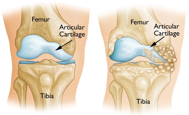 normal knee anatomy and osteoarthritic kneeeoarthritis that has damaged just one side of the knee joint. 