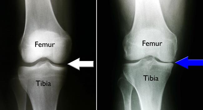 x-rays show normal joint space in knee and osteoarthritis on one side of knee