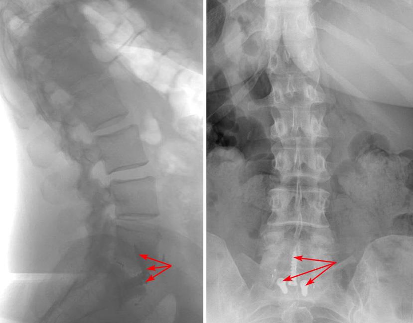 x-ray of anterior interbody fusion