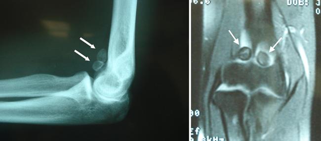 x-ray of synovial chondromatosis loose bodies in elbow 