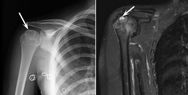 (Left) X-ray shows a chondroblastoma at the upper end of the humerus (upper arm bone). Note the white rims outlining the tumor. (Right) An MRI scan of the same tumor. 
