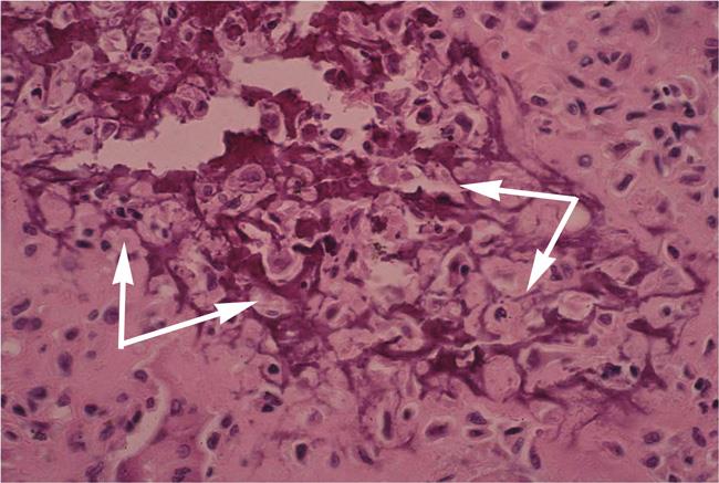 chondroblastoma pathology slide