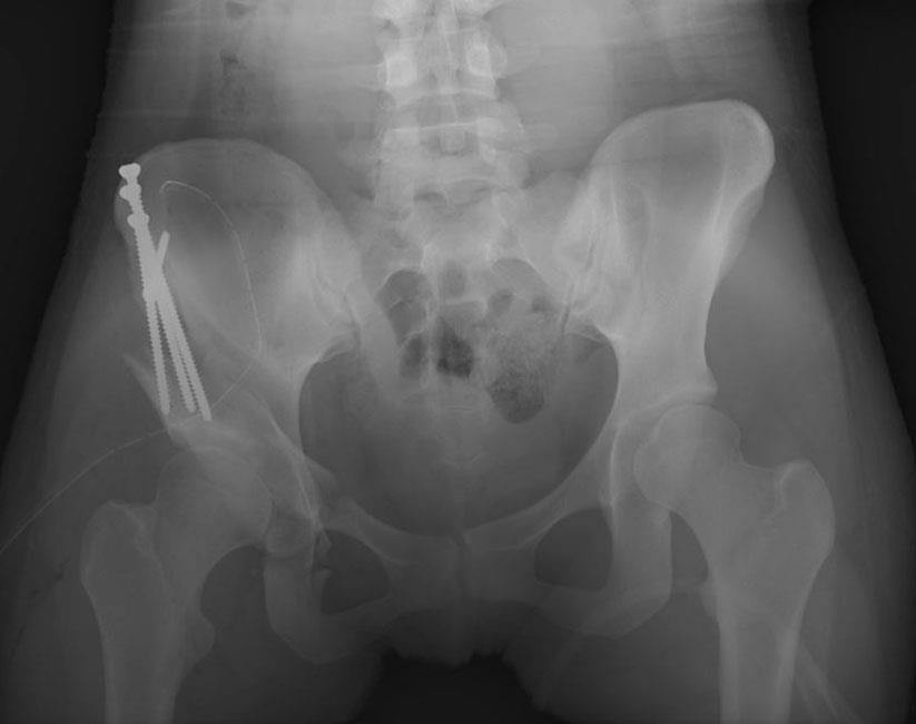 periacetabular osteotomy with screw fixation