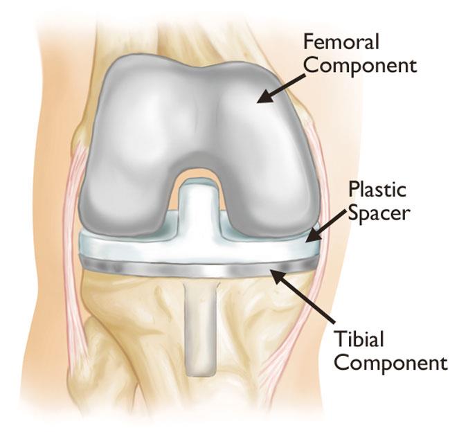 knee replacement implant