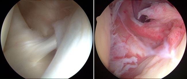 Estas fotos tomadas a través de un artroscopio muestran el revestimiento articular de un hombro normal (izquierda) y un revestimiento articular inflamado, dañado por el hombro congelado (derecha). 