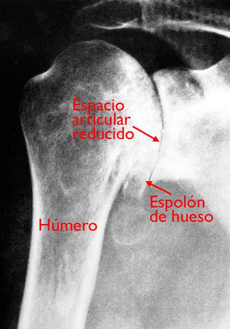 Estos rayos X muestran osteoartritis severa de la articulación glenohumeral. 