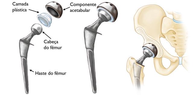 (Esquerda) Componentes individuais de uma artroplastia total de quadril. (Centro) Componentes unidos para formar um implante. (Direita) Implante colocado no quadril. 