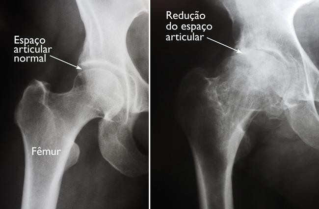 (Esquerda) Nesta radiografia de um quadril normal, o espaço entre a esfera e a cavidade indica uma cartilagem saudável. (Direita) Esta radiografia de um quadril com artrite mostra perda grave do espaço articular. 