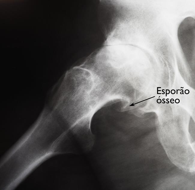 Esta radiografia mostra um grande esporão ósseo desenvolvido na esfera de um quadril com artrite. 