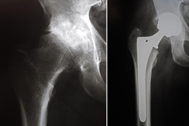 Radiografias antes e depois da realização da artroplastia total de quadril. Neste caso, foram usados componentes não cimentados. 