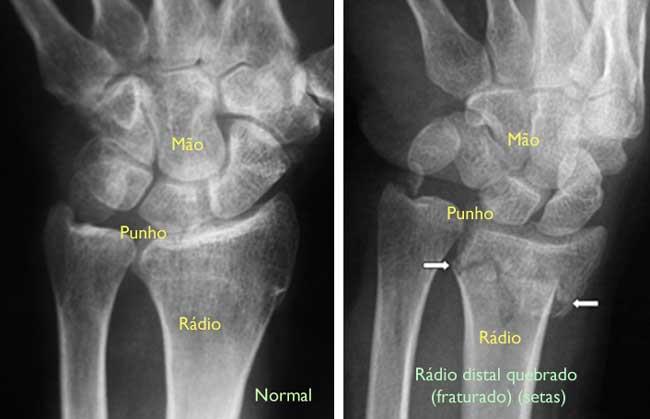 (Esquerda) Radiografia de um punho normal. (Direita) As setas brancas indicam uma fratura distal do rádio. 