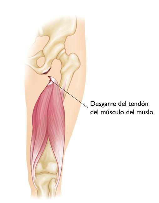 Una severa lesión al músculo del muslo donde el tendón se ha desgarrado del hueso. 