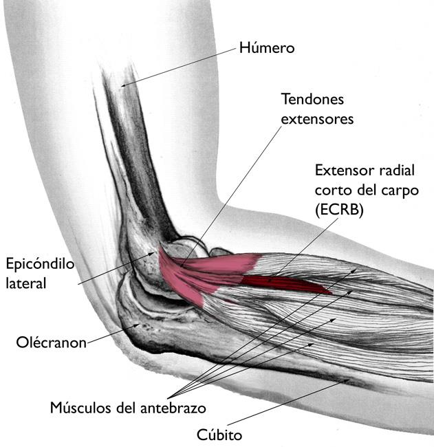 El músculo ECRB y el tendón usualmente están involucrados en el codo de tenista 