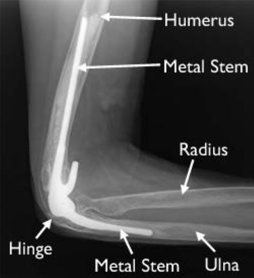 An x-ray of a total elbow replacement