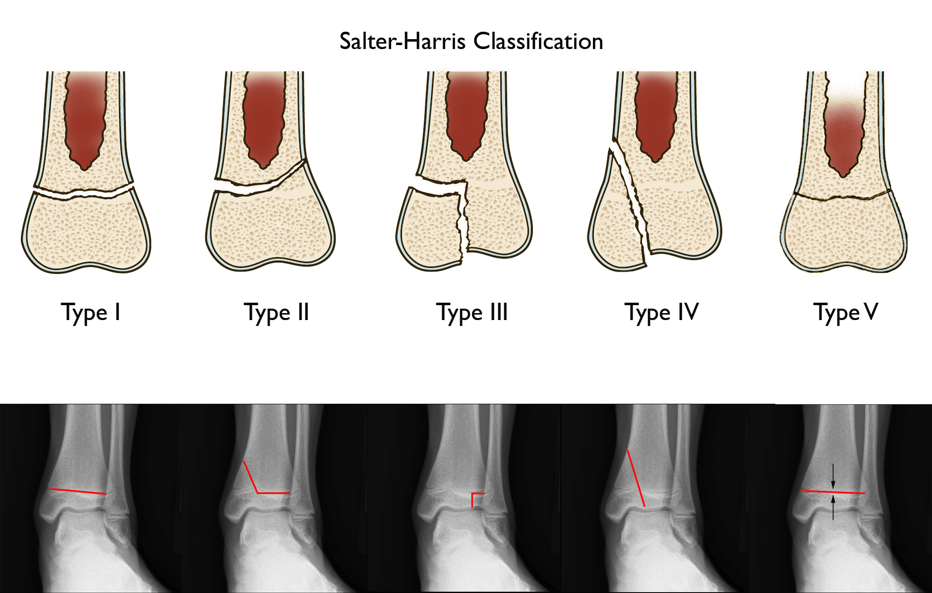 salter-harris growth plate fracture classification