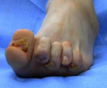 Severe claw toe