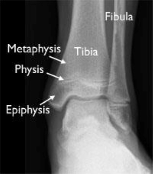 x-ray of growth plates in distal tibia