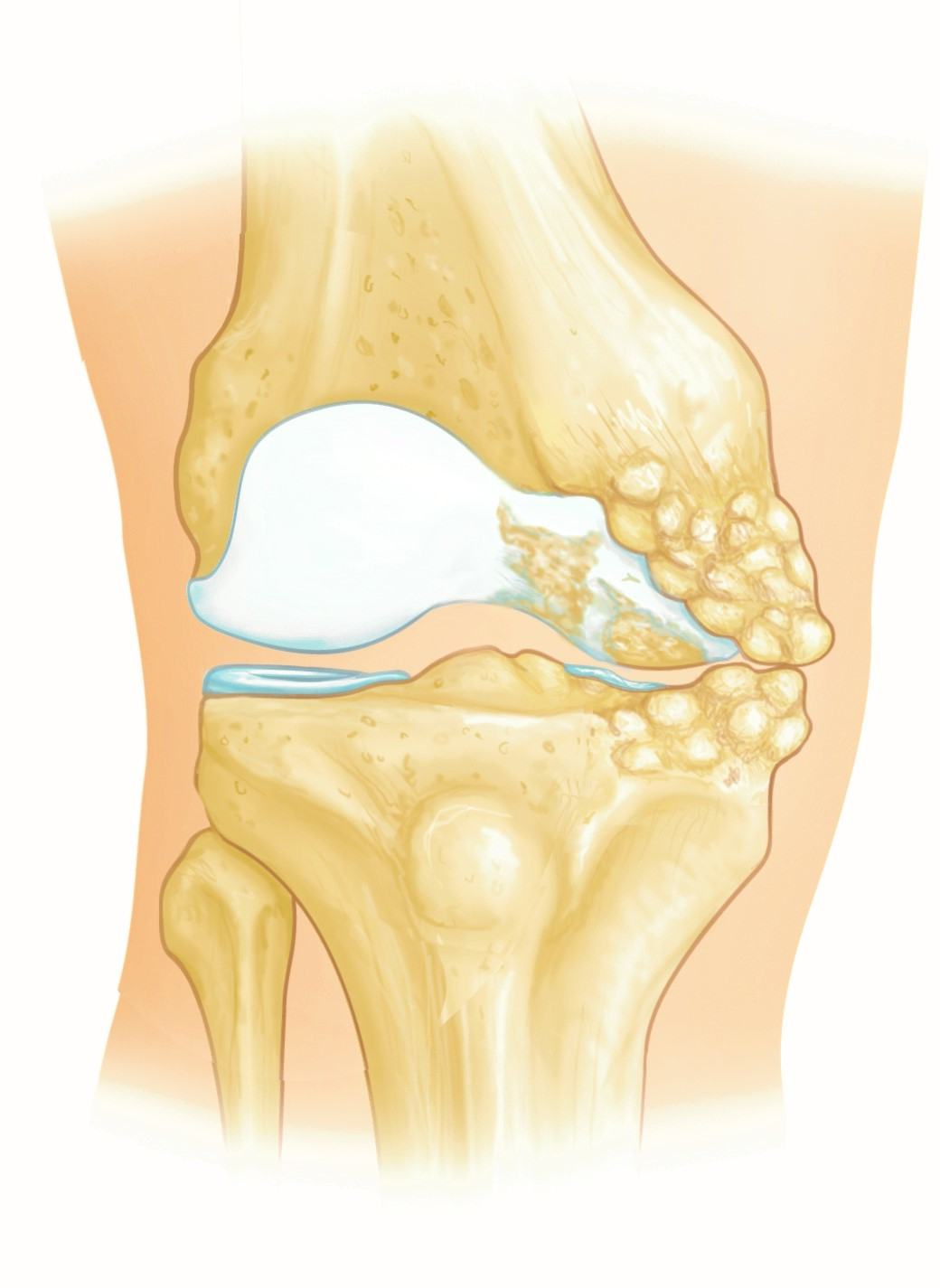 Osteoarthritis limited to medial compartment of the knee