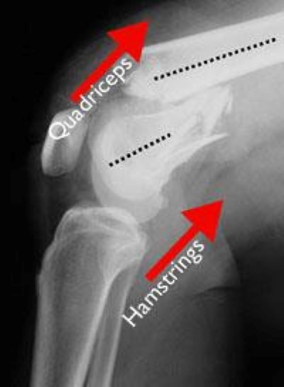 Distal femur fracture in which the bones are out of alignment