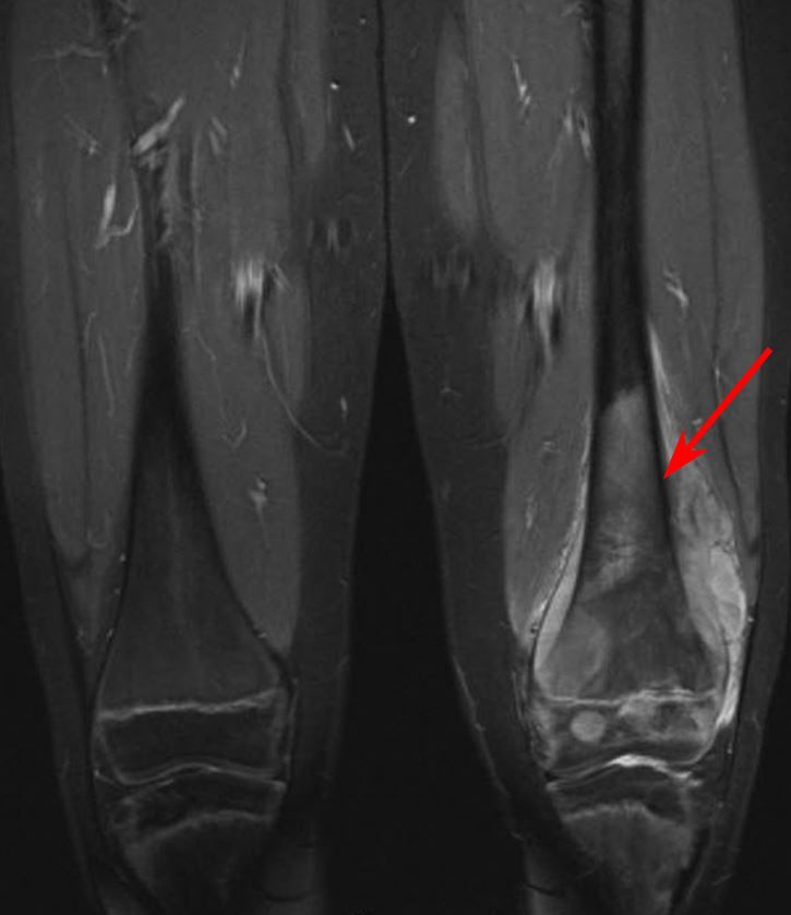 MRI scan of osteosarcoma in thighbone