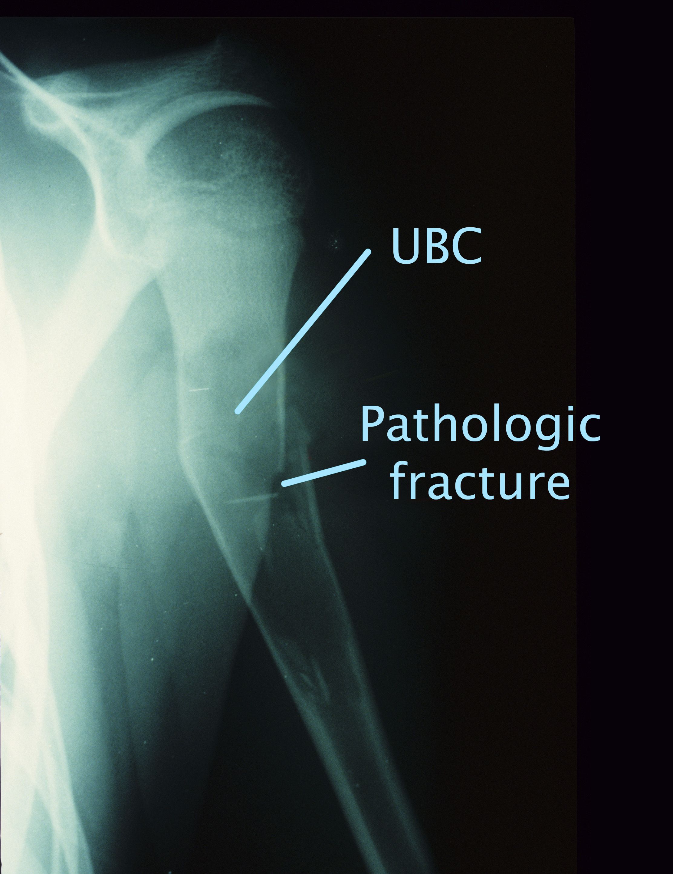 Unicameral bone cyst and pathologic fracture