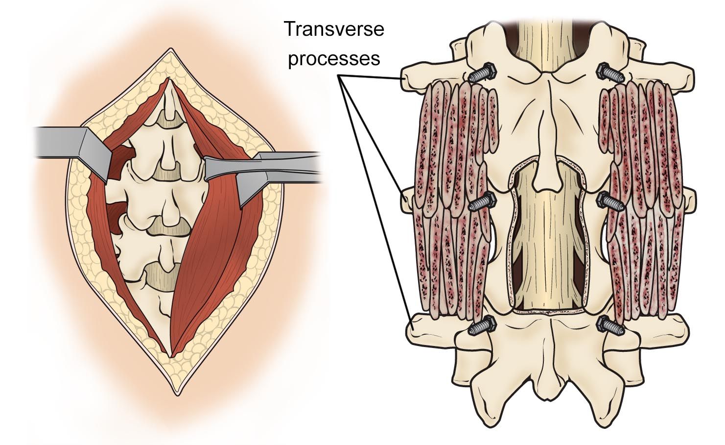 lumbar spine decompression and bone graft placement