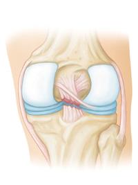 Complete tear of the posterior cruciate ligament